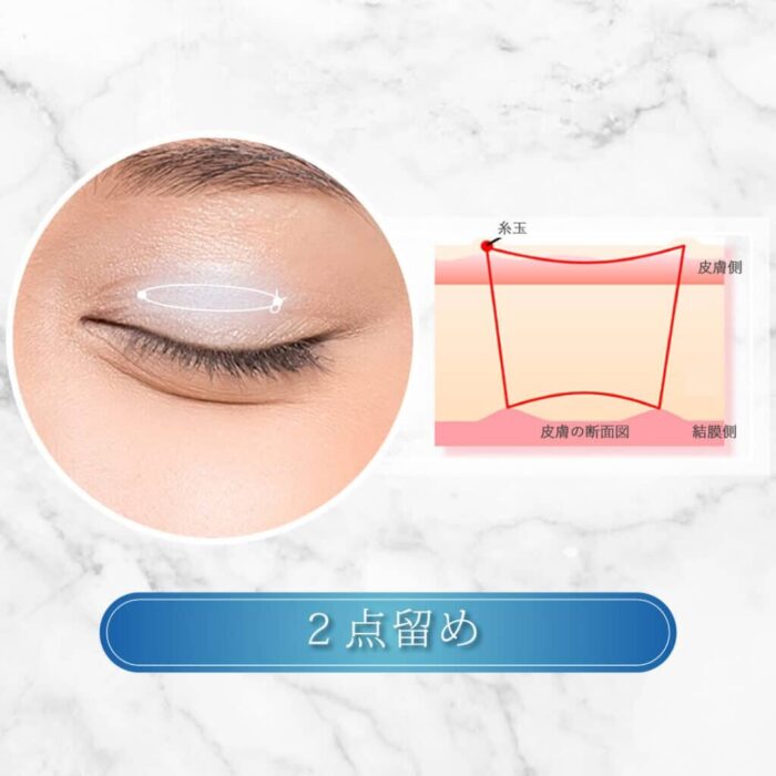 eクリニックの二重整形_二重埋没の2点留めの図解