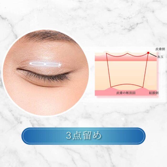 eクリニックの二重整形_二重埋没の3点留めの図解