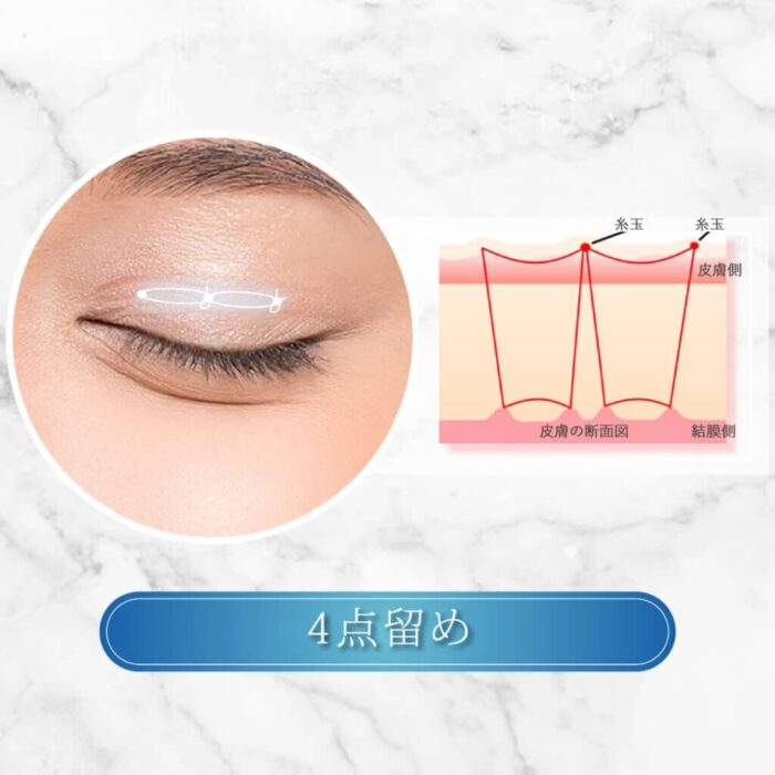 eクリニックの二重整形_二重埋没の4点留めの図解