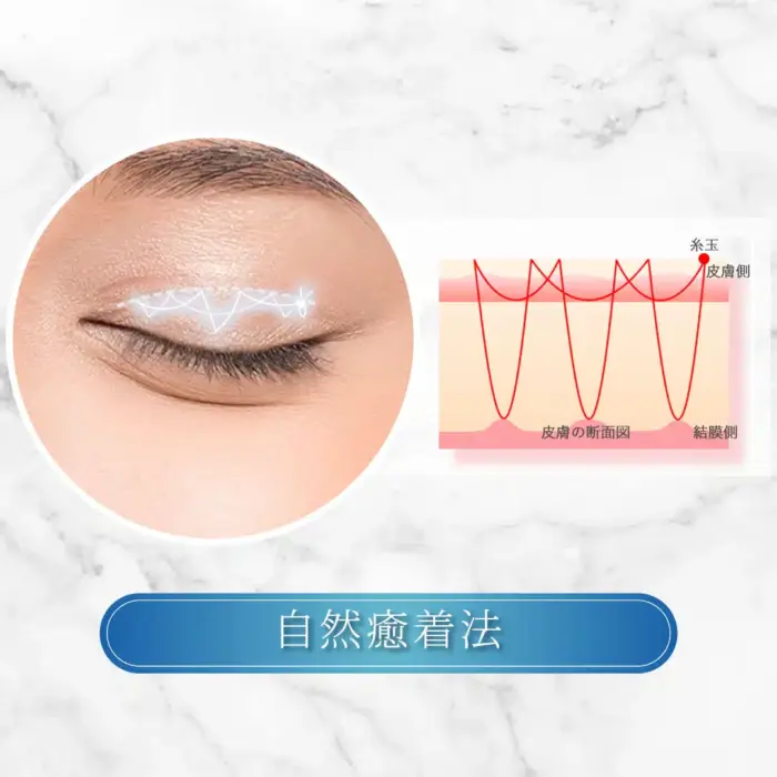 eクリニックの二重整形_二重埋没の自然癒着法の図解