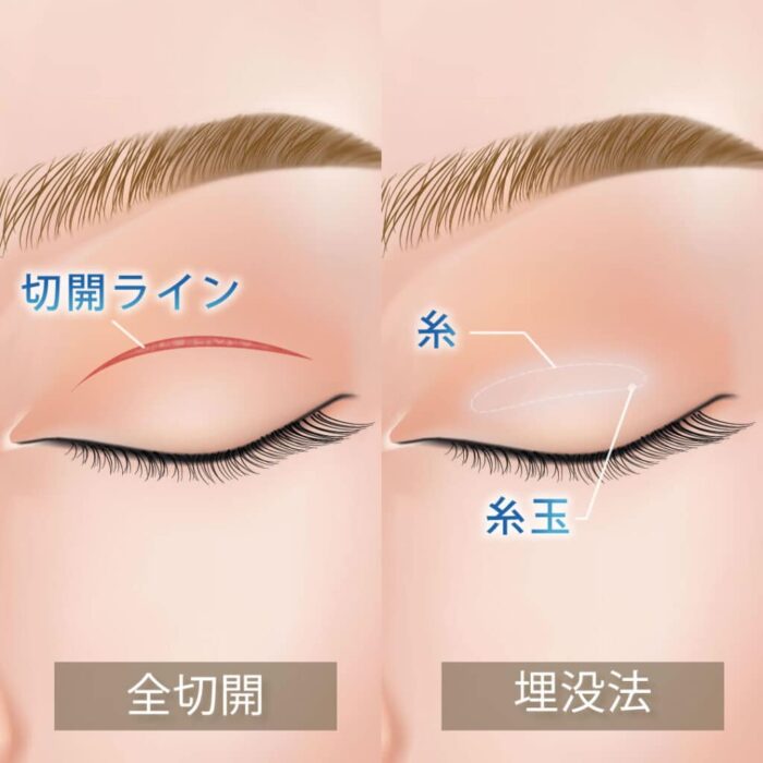 二重整形_埋没法と切開法の違い_図解