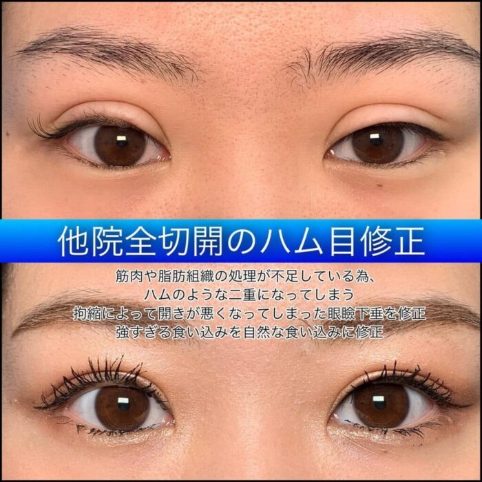 二重整形症例　他院修正