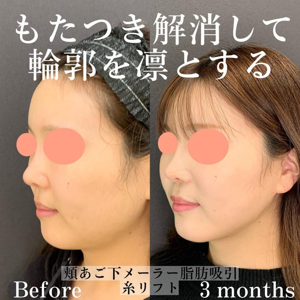 糸リフト症例