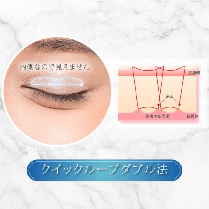 eクリニックの二重整形_二重埋没のクイックループ・クイックループダブルの図解