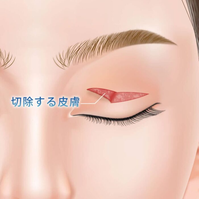 eクリニックの二重整形_二重切開のたるみ取り併用全切開二重術の図解