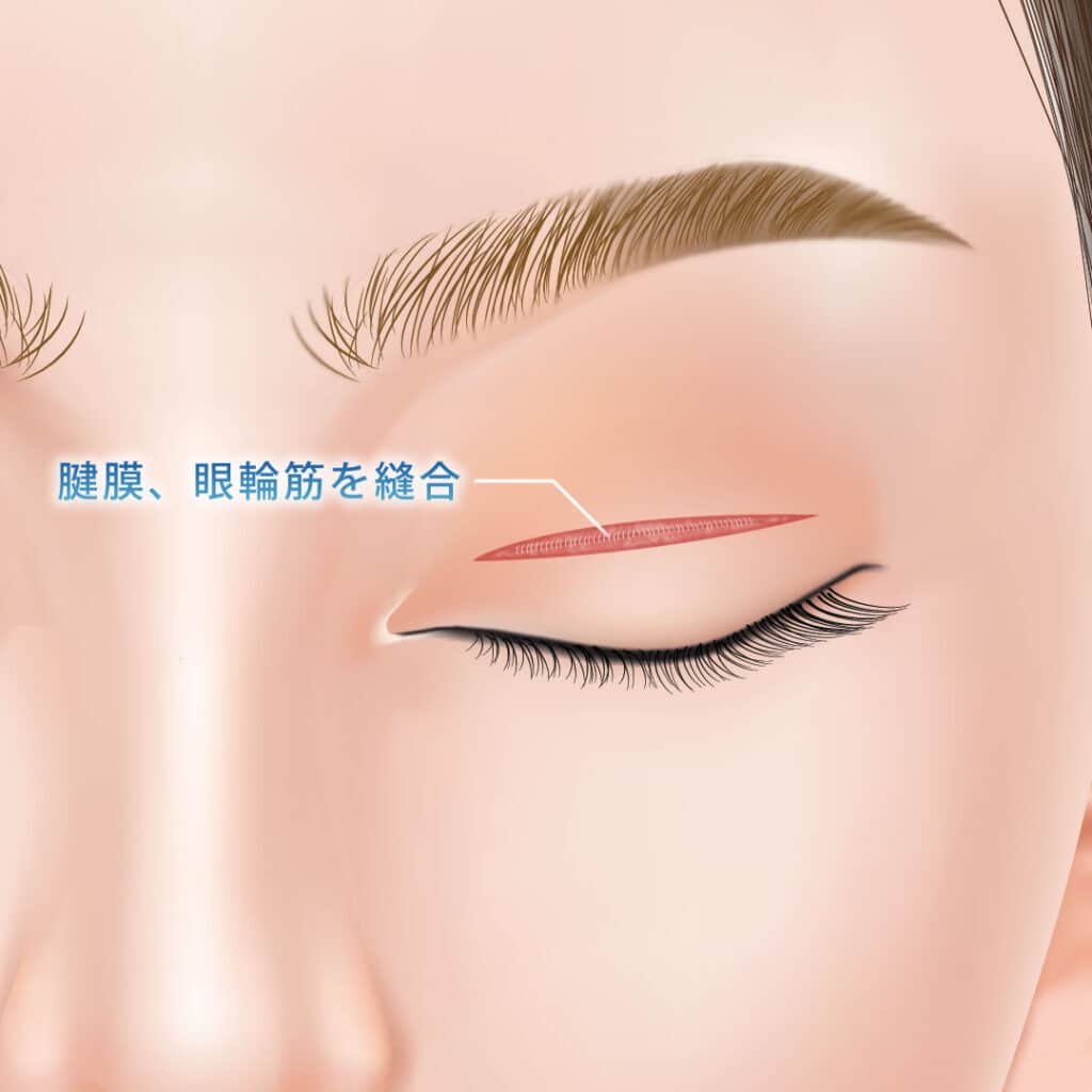 二重全切開の手術方法3