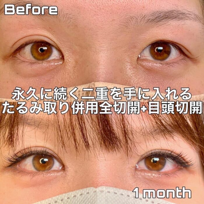 二重全切開＋目頭切開