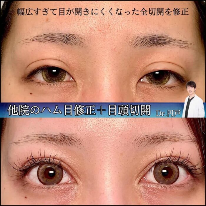 二重切開他院修正