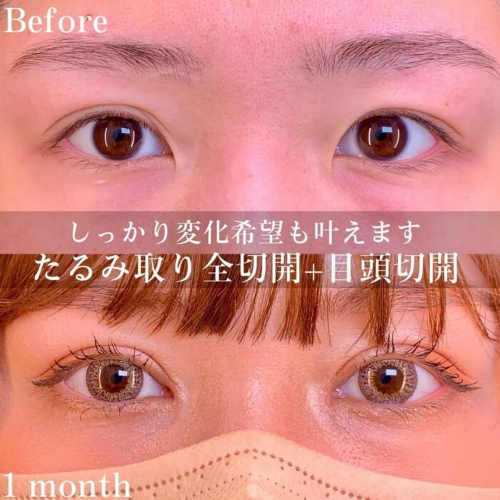 全切開＋目頭切開