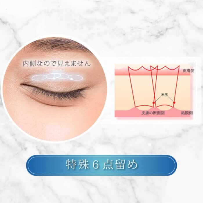 eクリニックの二重整形_二重埋没の特殊6点留めの図解