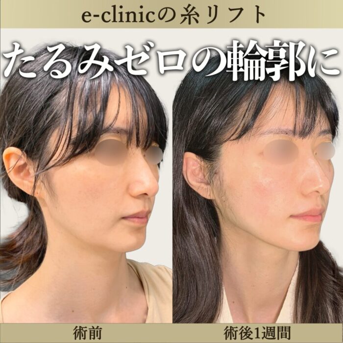 糸リフト症例