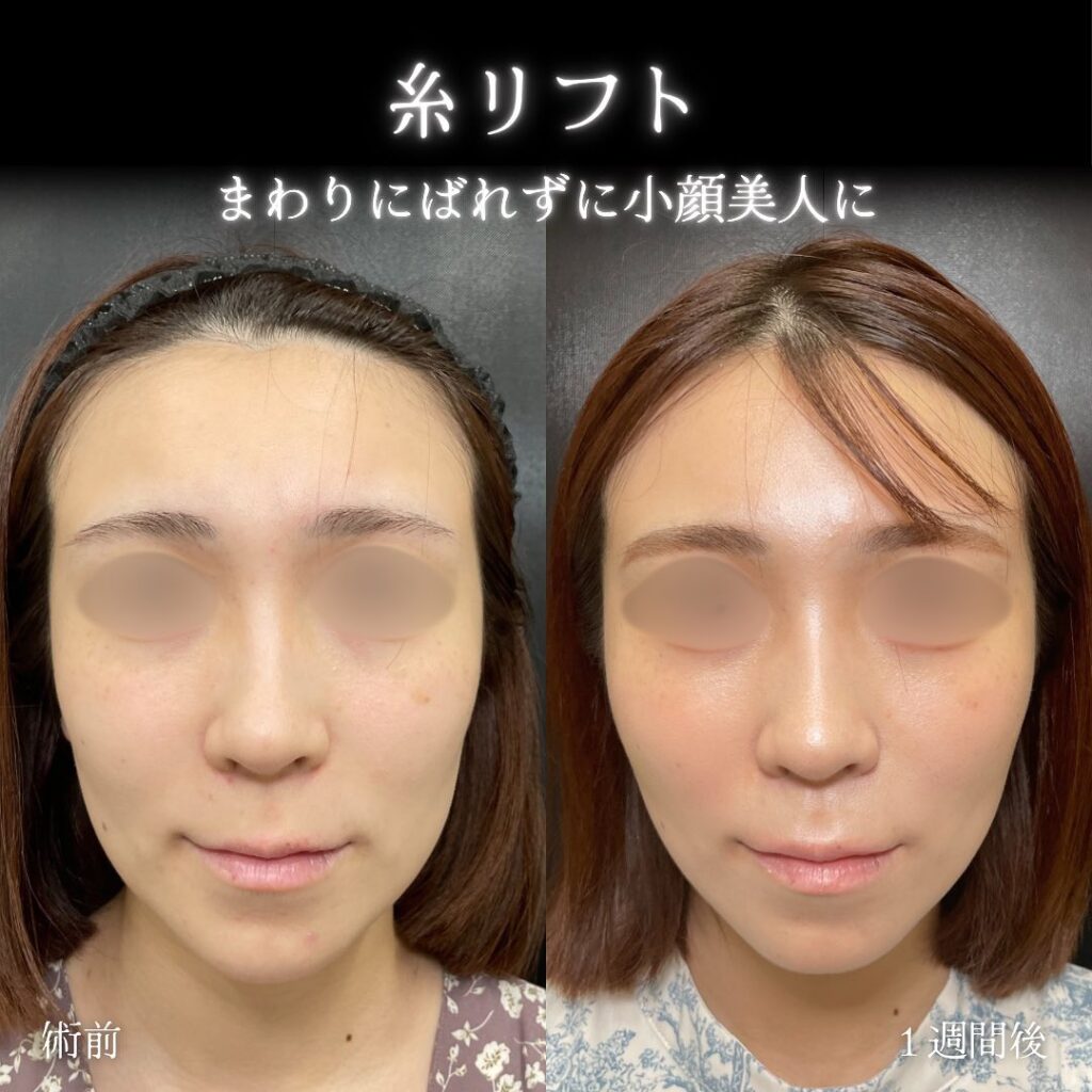 糸リフト症例