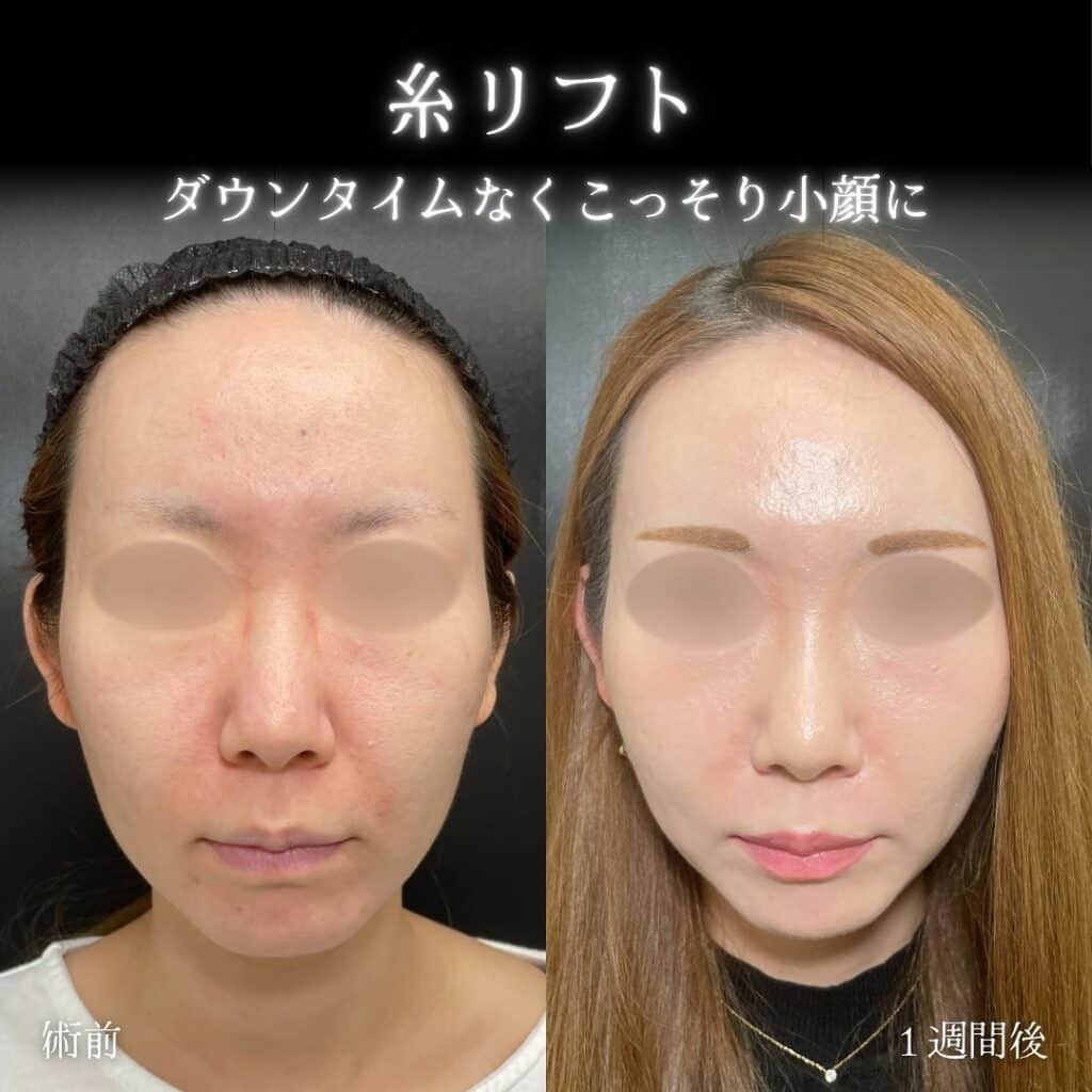 糸リフト症例