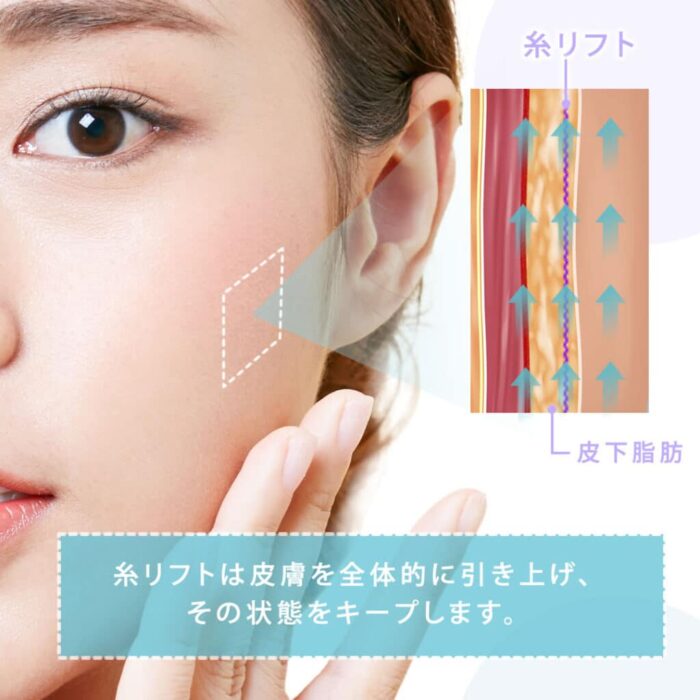 糸リフト図解