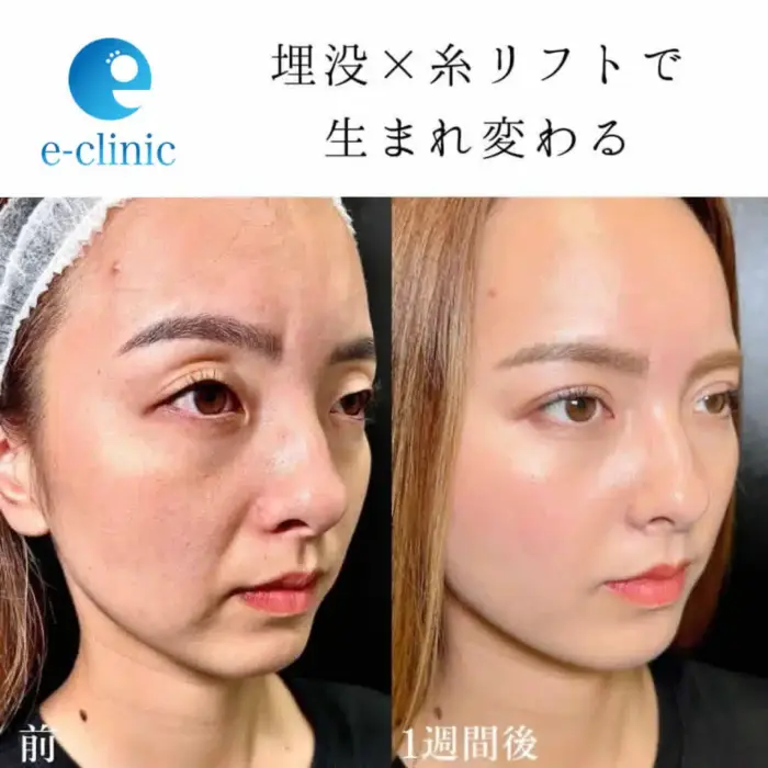 糸リフト症例