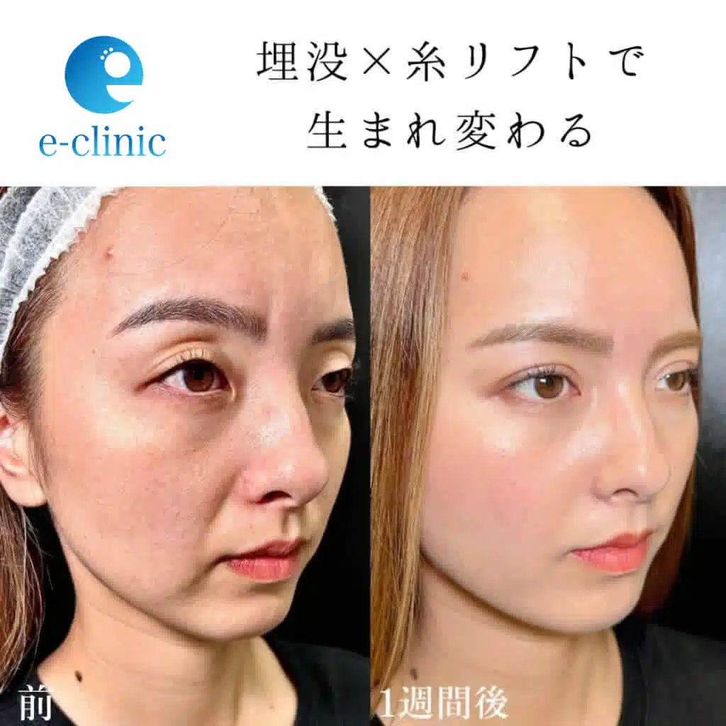 糸リフト症例