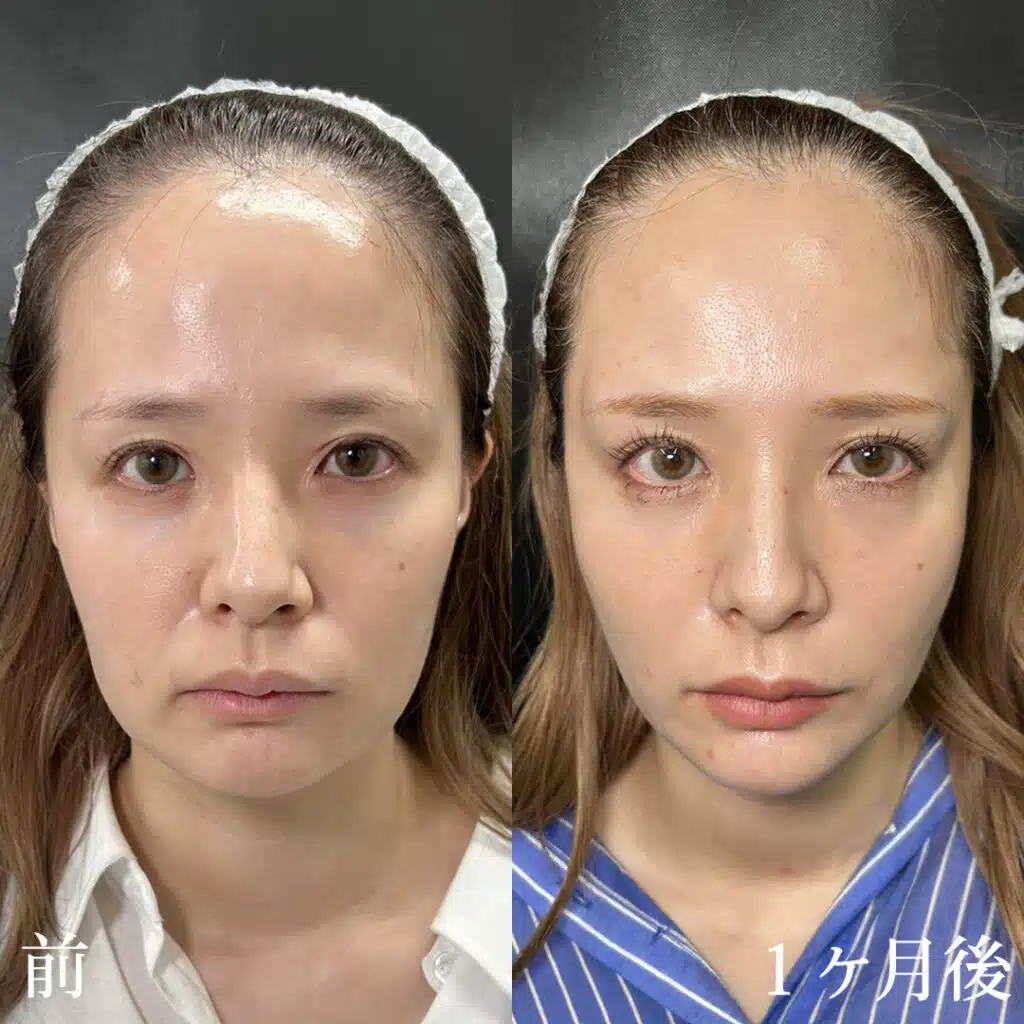 糸リフト症例