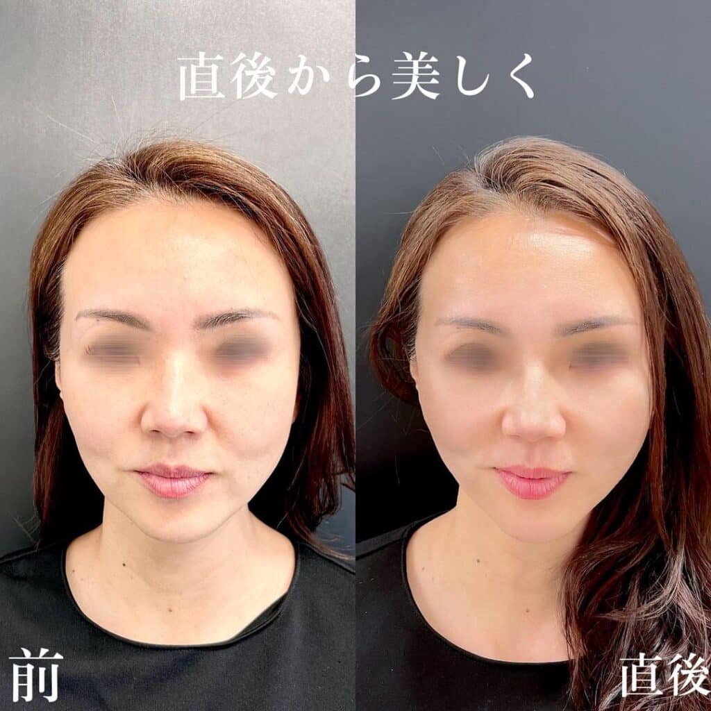 糸リフト症例