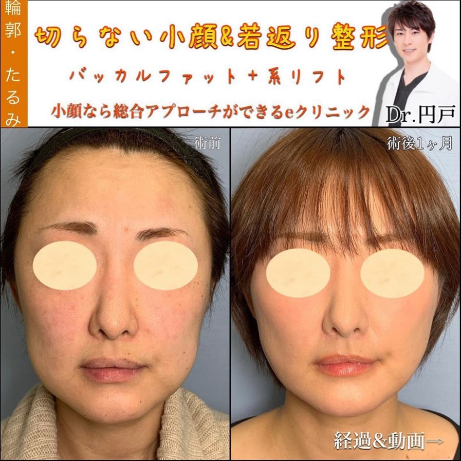 糸リフト症例