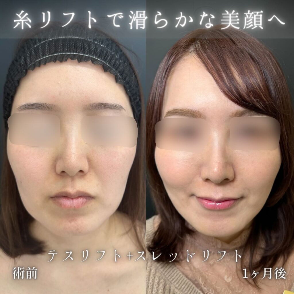 糸リフト症例