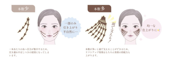 糸リフト図解