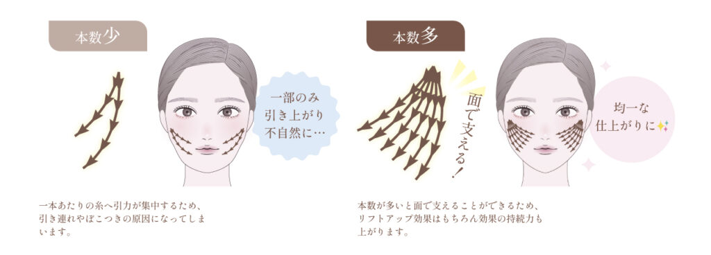 糸リフト図解