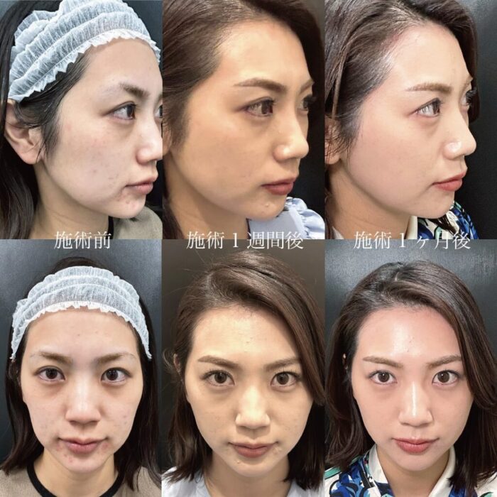 糸リフト症例経過
