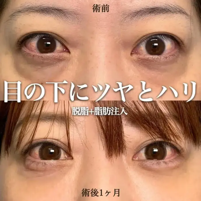 eクリニックの経結膜脱脂＋脂肪注入（切らないクマ取り）