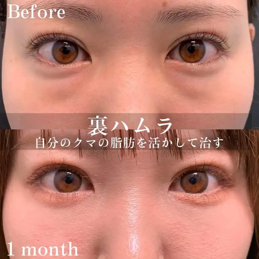 裏ハムラ法