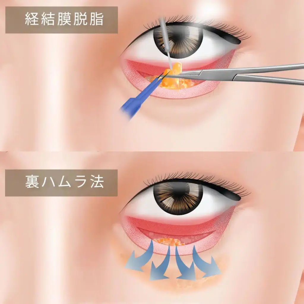 裏ハムラ法と経結膜脱脂術との違い