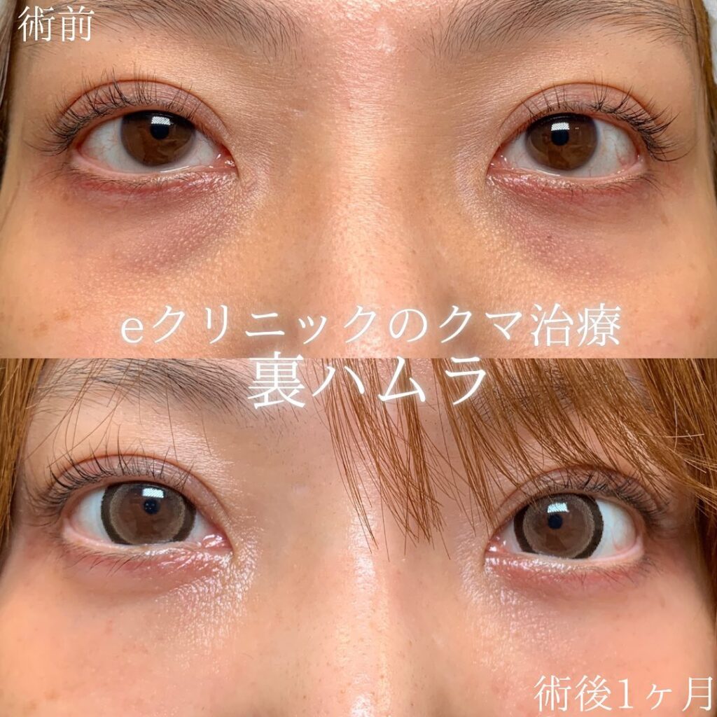裏ハムラ法症例写真