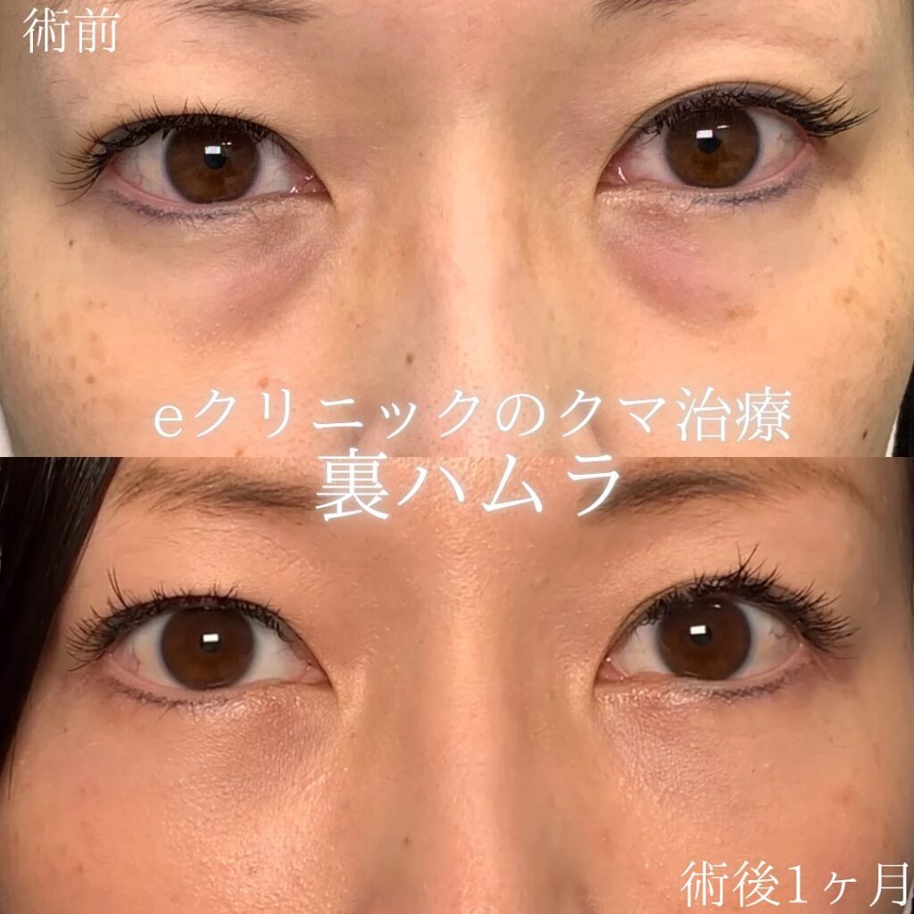 裏ハムラ法症例写真