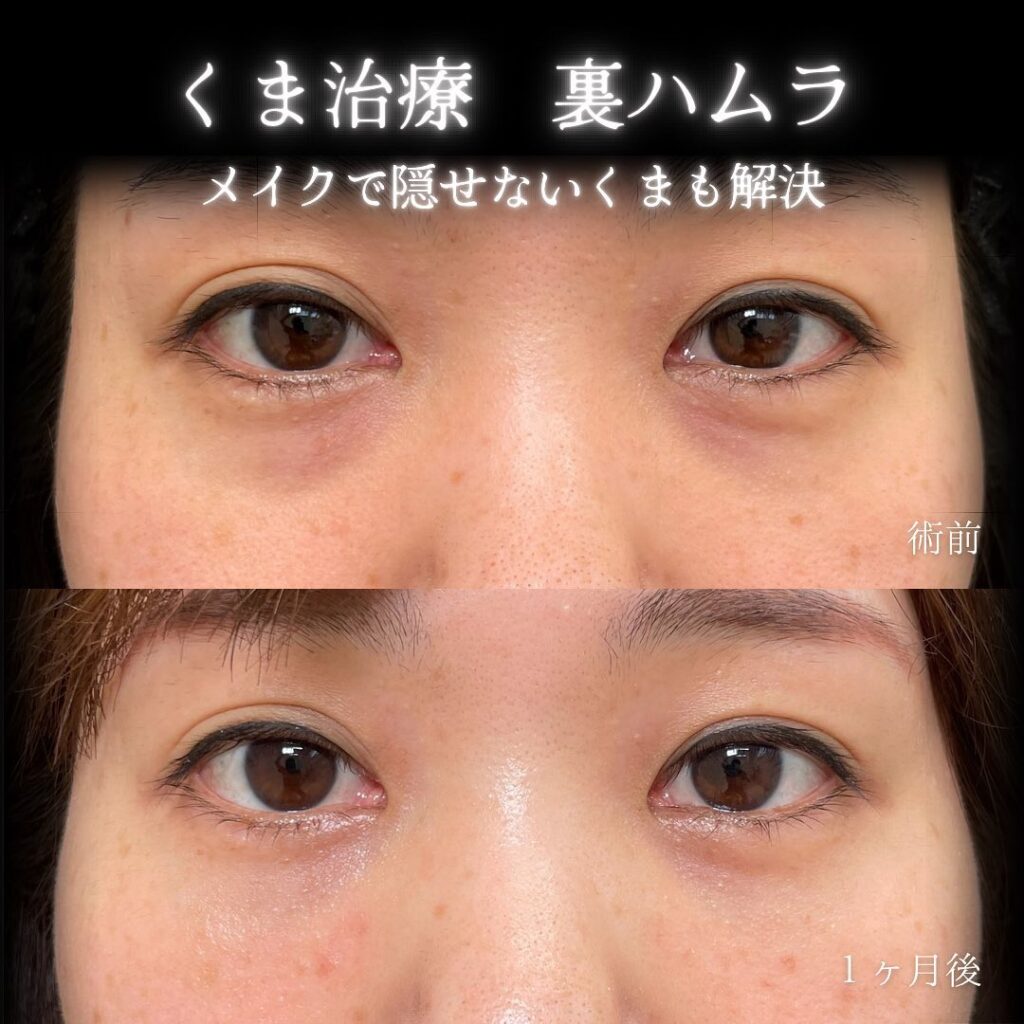 裏ハムラ法症例写真