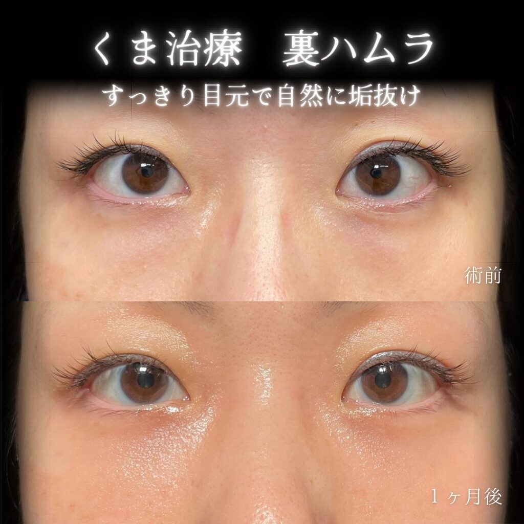 裏ハムラ法症例写真