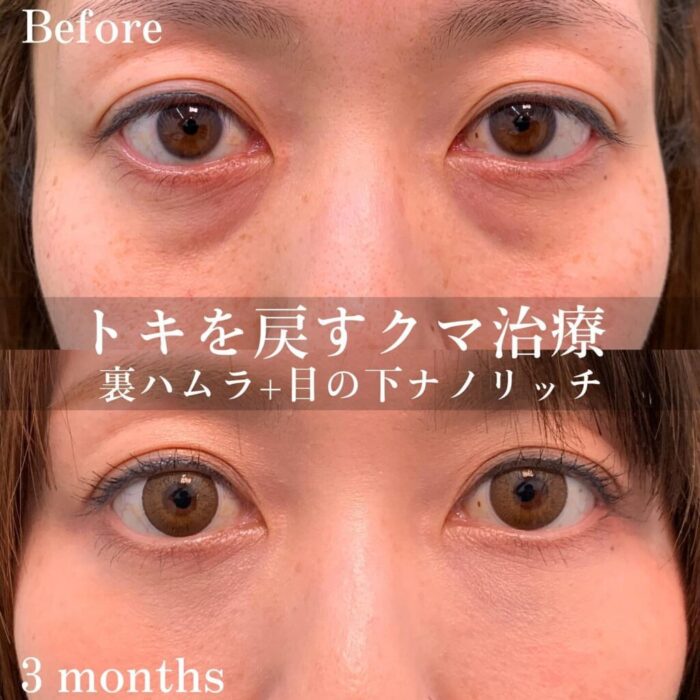 裏ハムラ症例