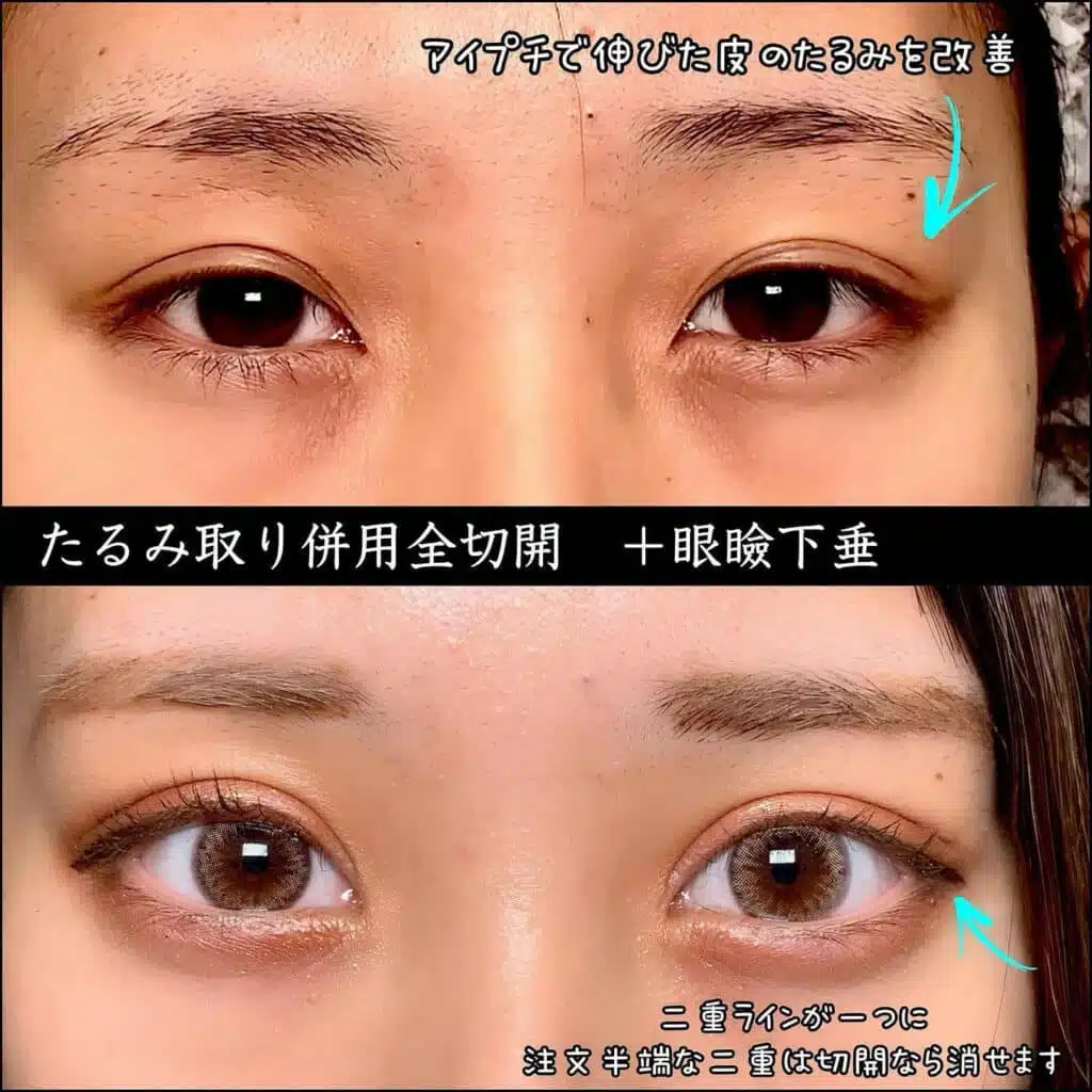 たるみ取り併用全切開 眼瞼下垂