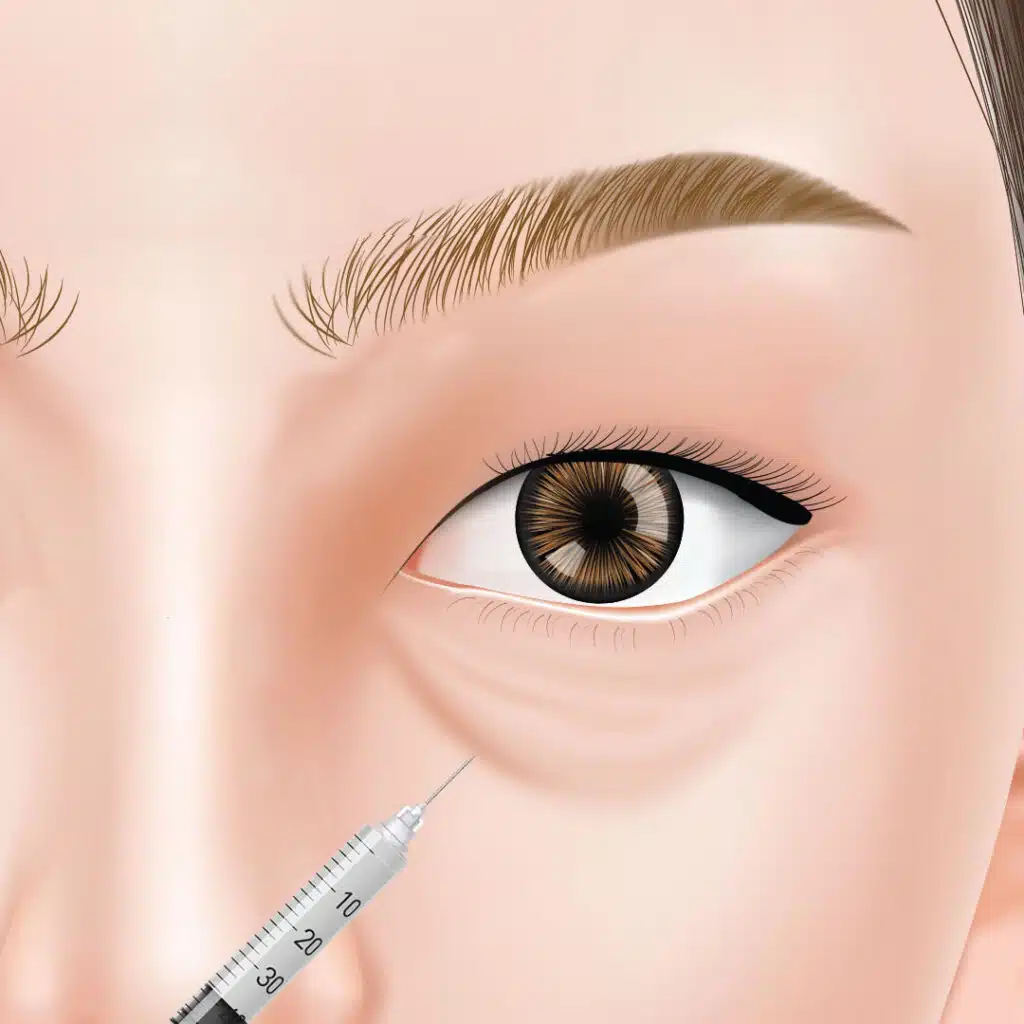 目の下のヒアルロン酸注射