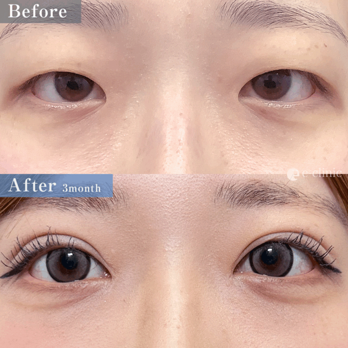 二重埋没法_埋没4点留め+目頭切開(名医の「脇谷雄一郎医師が執刀)