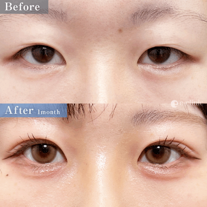 二重埋没法_埋没4点留め(名医の脇谷雄一郎医師が執刀)