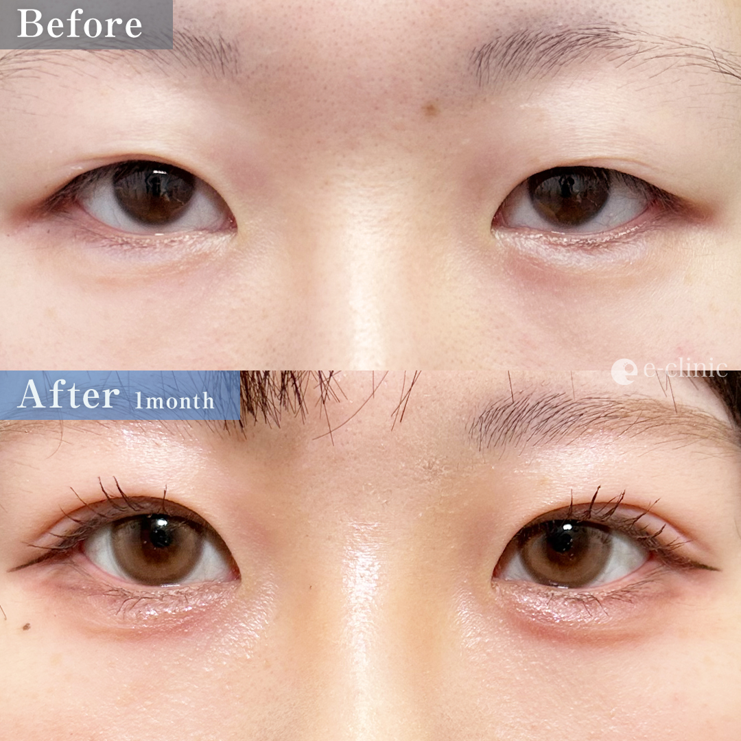 二重埋没法_埋没4点留め（名医の脇谷雄一郎医師が執刀）