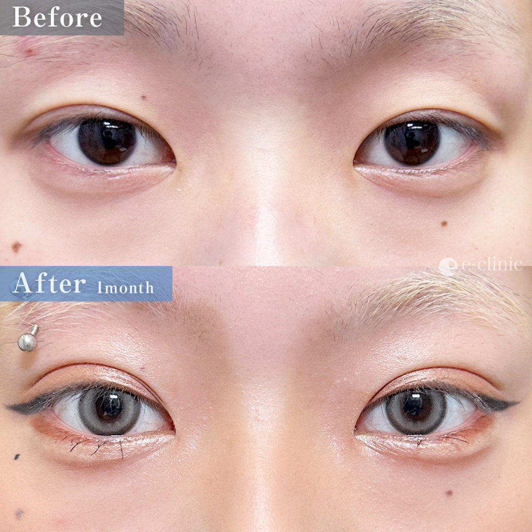 二重埋没法_埋没4点留め（名医の脇谷雄一郎医師が執刀）