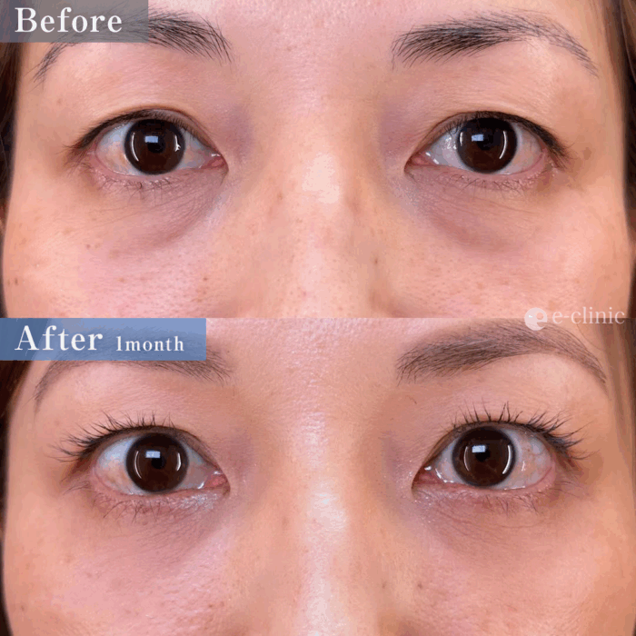 クマ取り_裏ハムラ法(名医の島田良浩医師が執刀)