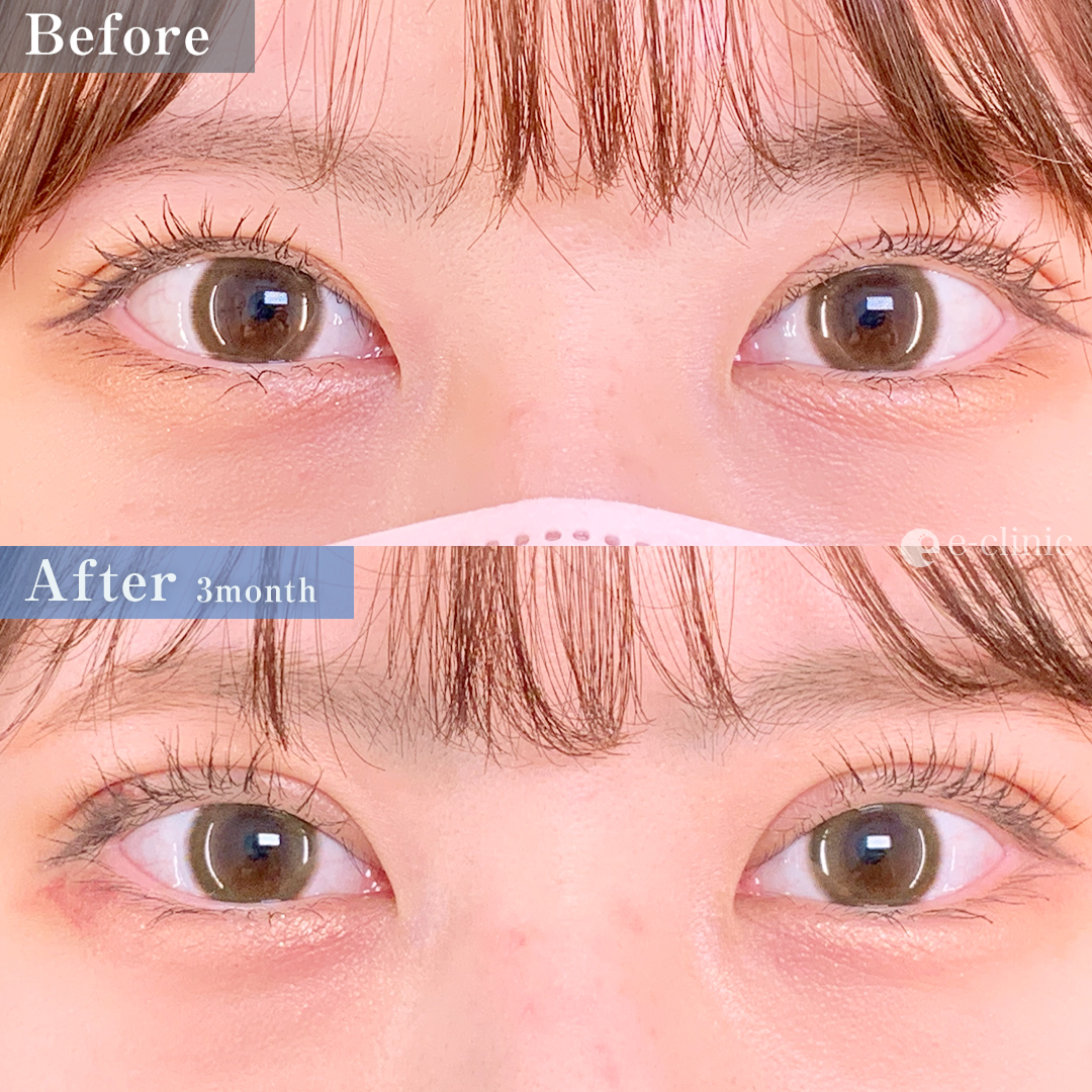 たるみ取り併用全切開二重術＋目の上脱脂（名医の張田修平医師が執刀）