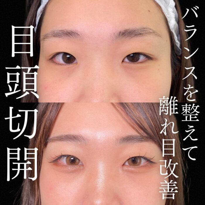 離れ目 目頭切開