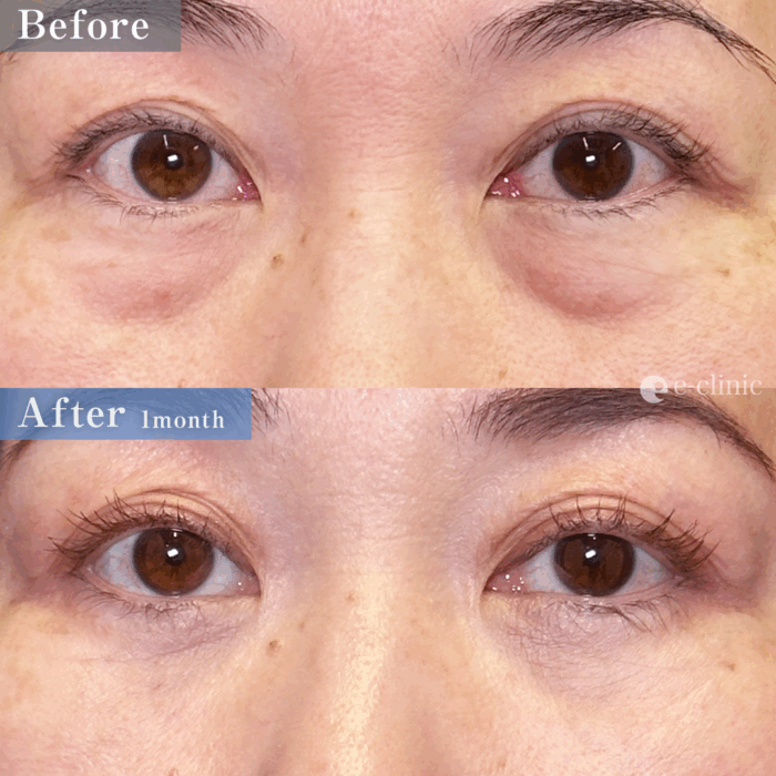 クマ取り_裏ハムラ法(名医の坂本優衣医師が執刀)(32)