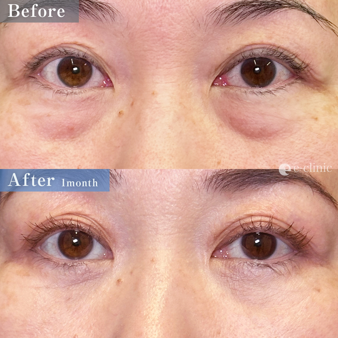 クマ取り_裏ハムラ法（名医の坂本優衣医師が執刀）