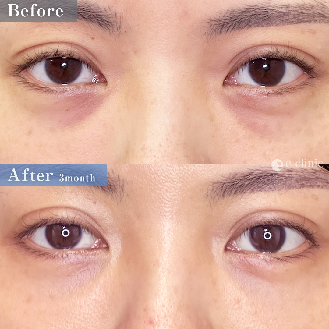 クマ取り_裏ハムラ法（名医の坂本優衣医師が執刀）