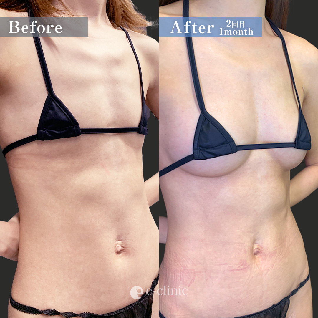 ①ピュアグラフト＋②コンデンス豊胸（名医の田中里佳医師が執刀）