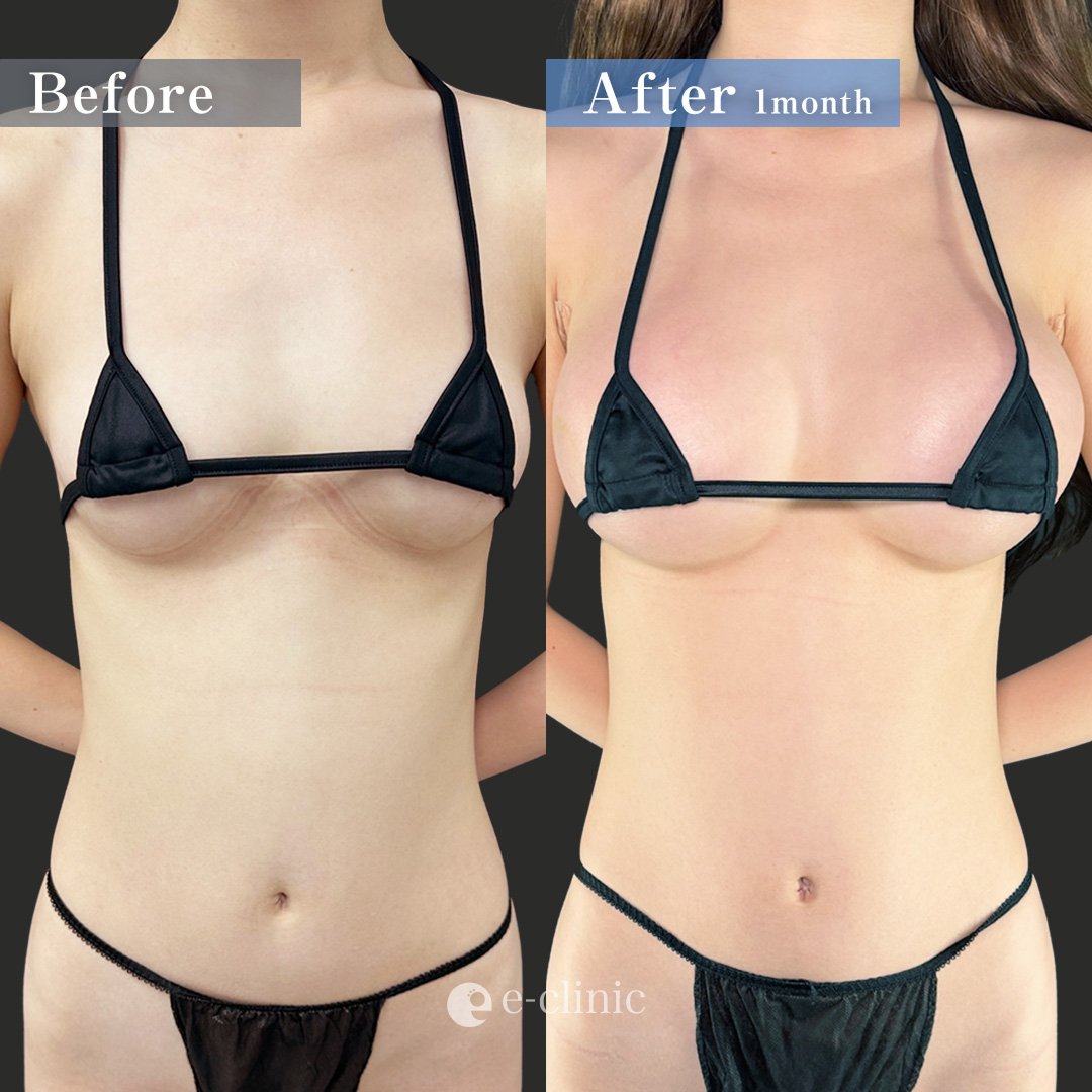 ハイブリッド豊胸（名医の田中里佳医師が執刀）