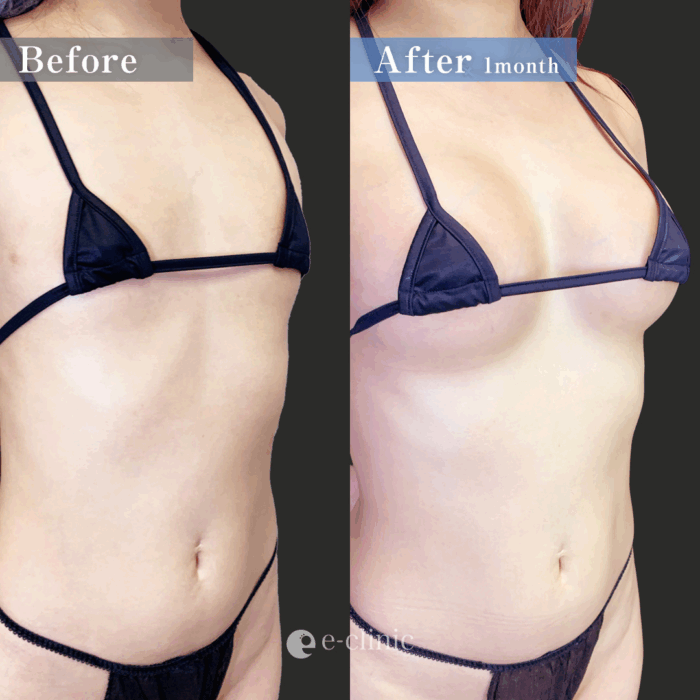 ハイブリッド豊胸（名医の田中里佳医師が執刀）（37）